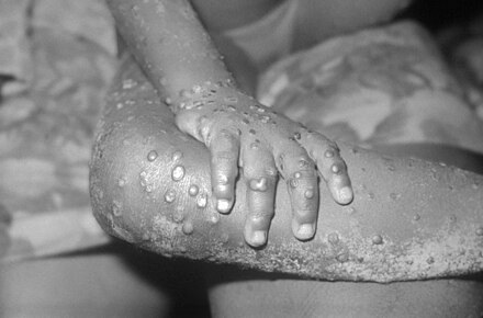 MONKEYPOX: Causes, Symptoms, Treatments