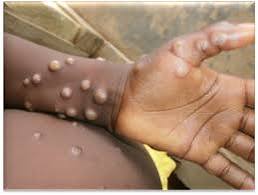 Osun State Records Two Cases Of Monkeypox