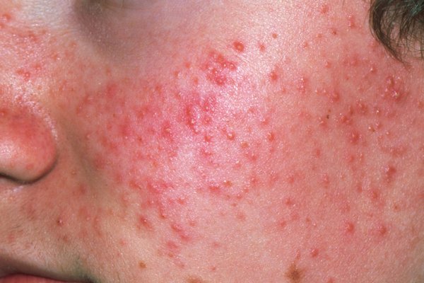 ACNE: Causes, Development, Effective Home Remedies