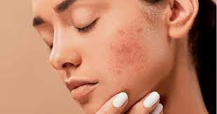 Understanding and Managing Acne and Eczema for Healthier Skin