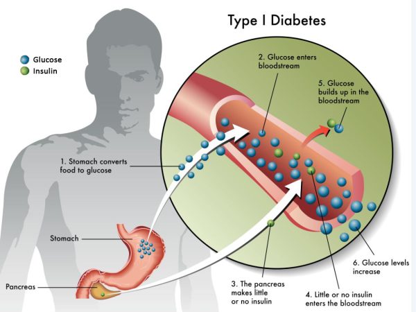 Diabetes: Types, Symptoms, Treatment, and Prevention