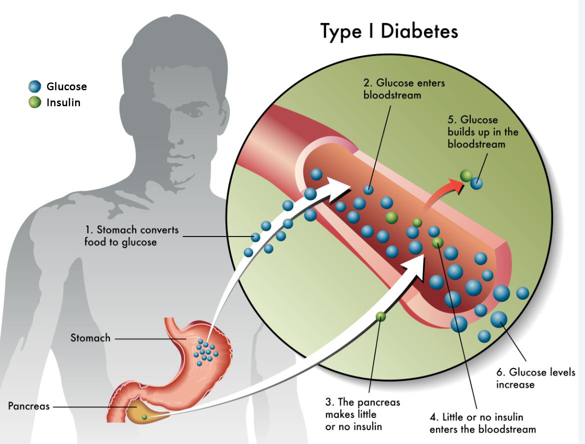 Diabetes: Types, Symptoms, Treatment, and Prevention